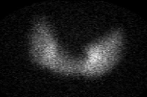 Thyroid Uptake Scan Showing Diffuse Uptake In Both Lobes Consistent