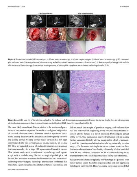 Early Cervical Cancer Recurred With Uterine Fundus Metastasis After