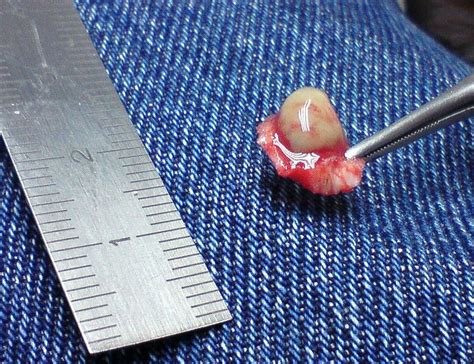 Plantar wart surgery - wikidoc