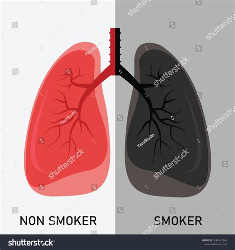 Smoke Vape Causes Lung Disease E-cigarette Stock Vector (Royalty Free ...