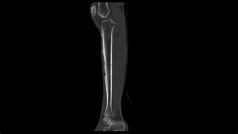 Bone Involvement In Secondary Syphilis Proliferative Periostitis And