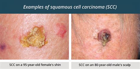 Skin Cancer Types Squamous Cell Carcinoma