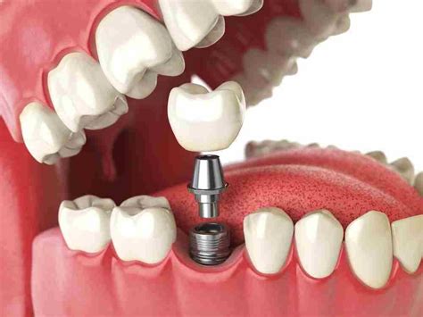 ¿cuál Es El Mejor Material Para Los Implantes Dentalesdental Clinic Dentists In Tijuana