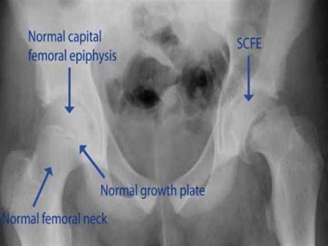 Slipped Upper Femoral Epiphysis (SUFE)