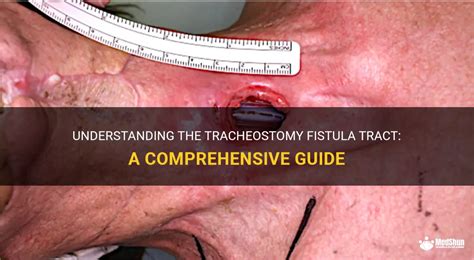 Understanding The Tracheostomy Fistula Tract A Comprehensive Guide