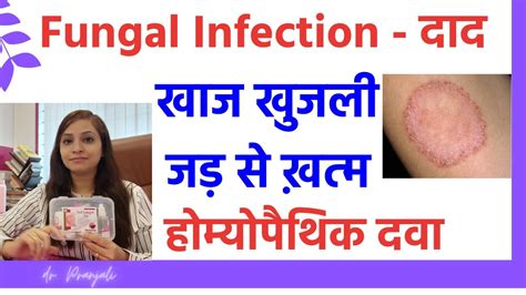 Fungal Infection Treatment By Homeopathy Ringworm Treatment Khujli