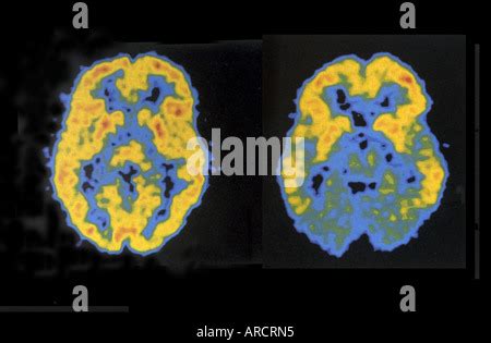 Tep del cerebro normal Fotografía de stock Alamy