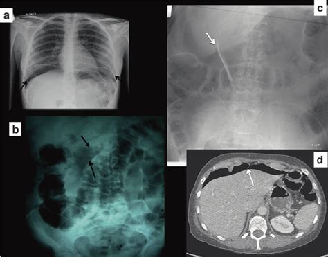 Signs Of Pneumoperitoneum I A Free Sub Diaphragmatic Gas On Chest