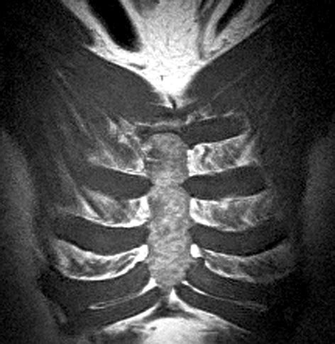 Sternum Mri Scan Medserena Open Mri