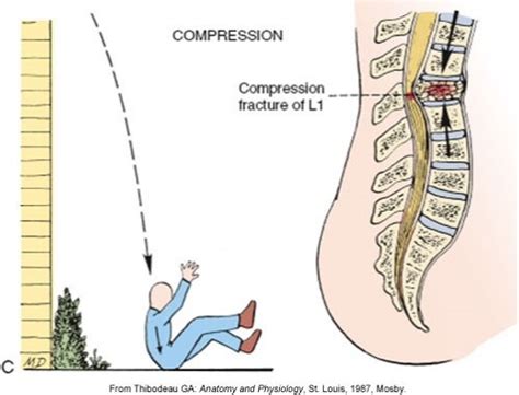 spinal cord compression  flashcards quizlet