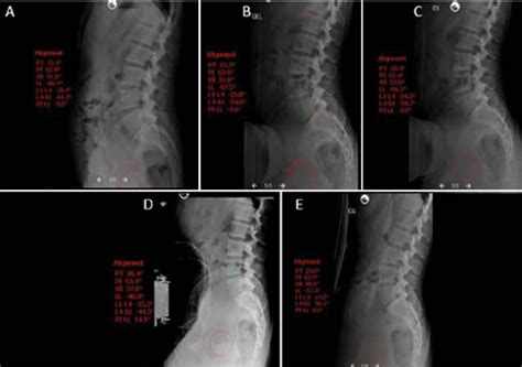 Scielo Brasil Lumbar Lordosis Variation According The Type Of