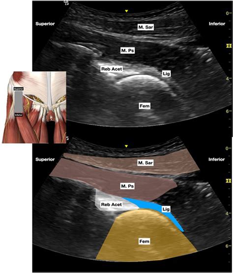 New Ultrasound Guided Capsular Blocks For Hip Surgery A Narrative