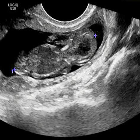 Transvaginal Ultrasound Showing A A Cesarean Scar Ectopic Pregnancy