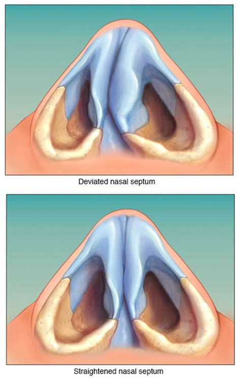 Deviated Septum - Causes, Symptoms, How To Fix A Deviated Septum