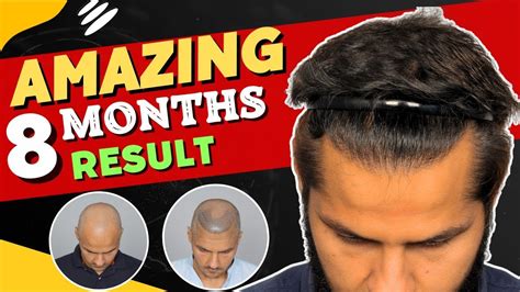 Hair Transplant In Mysore Best Results And Cost Of Hair Transplant In