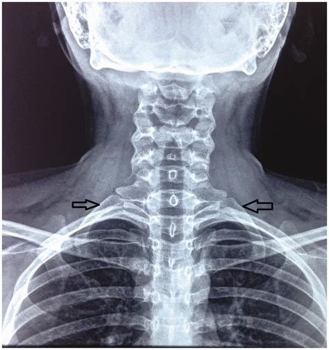 Bilateral Complete Bony Cervical Ribs Vinitha V Nair Bipin Thomas