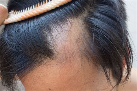 Alopecia Cicatricial Reversible O Irreversible NHC Te Ayuda