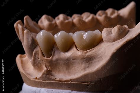 Mold Of Teeth Gypsum Model Plaster Of Teeth Stomatologic Plaster Cast