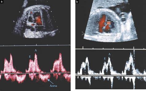 Color And Pulsed Doppler In Fetal Echocardiography Abuhamad 2004