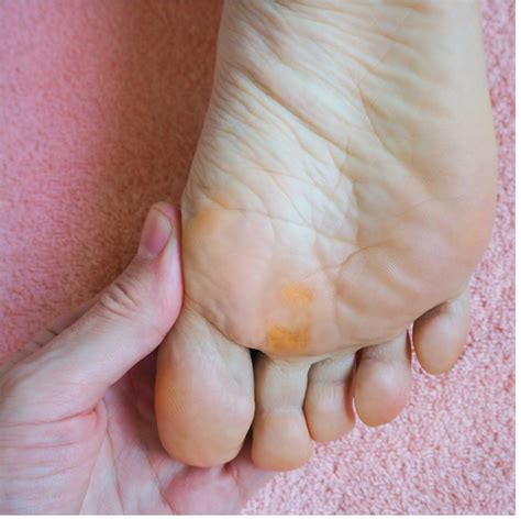 How To Remove A Callus From A Diabetic Foot Foot Corn Callus Removal