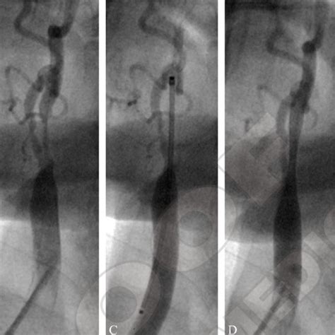 Carotid Artery Stenting Procedure A Selective Angiography Of Right Download Scientific