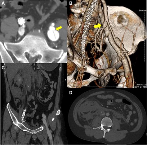 The Initial Computed Tomography Angiography Before The 2nd Operation