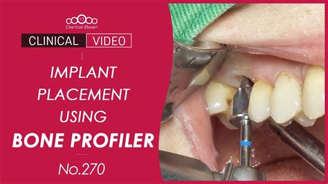 16 Implant Placement With Crestal Sinus Bone Augmentation Dr Cho