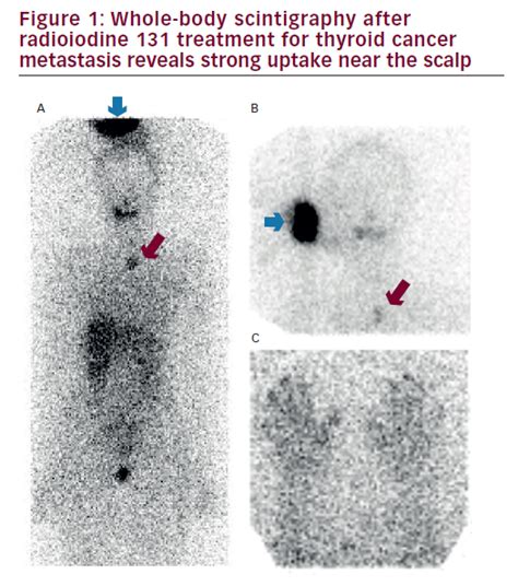 A Cutaneous False Positive In Radioiodine Scintigraphy For Metastatic