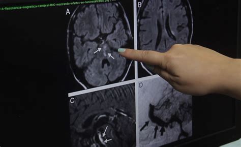 Resonancia Magn Tica De Aneurisma Cerebral