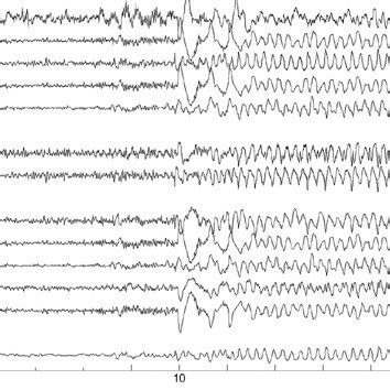 Stereo Eeg Recording Of A Seizure Montage As In Figure The Ictal