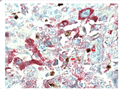 Immunohistochemical Staining Of Macrophages In Non Small Cell Lung