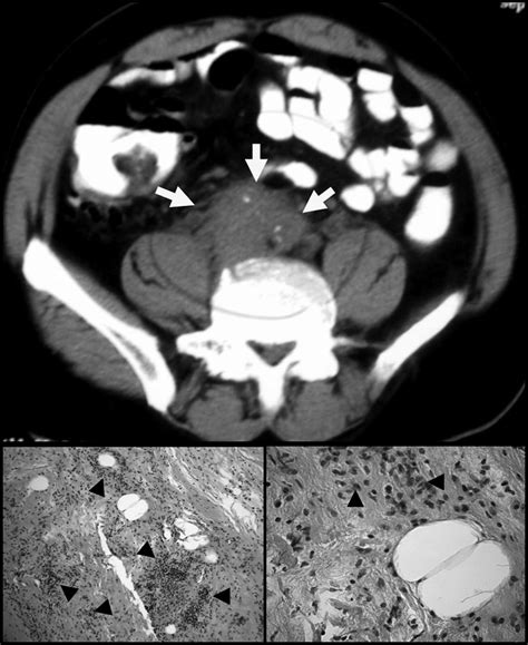 Fig Abdominal Ct Scan Without Contrast Showing Retroperitoneal Soft Download Scientific