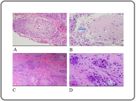 Squamous Cell Carcinoma Histology Ear