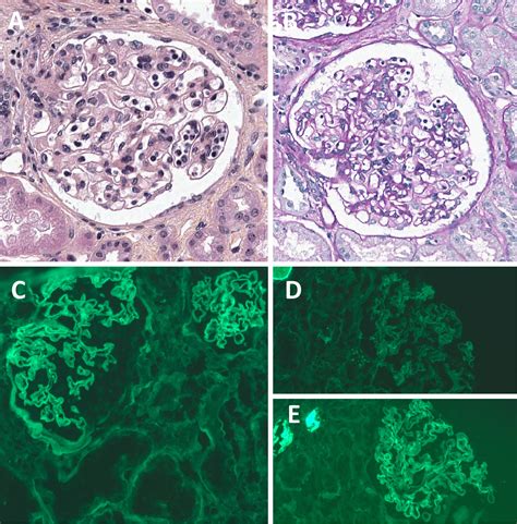 Atypical Anti Glomerular Basement Membrane Nephritis A Case Series