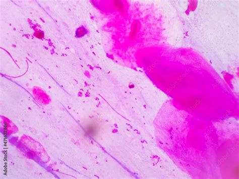 Prostatic Smear For Gram Staining Microscopic X Show Neisseria