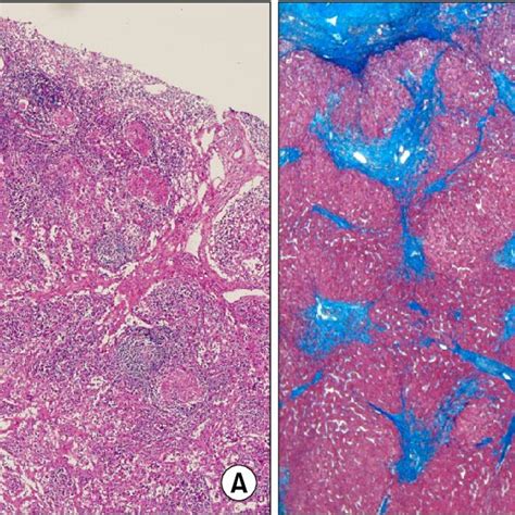 A Lymph Node Biopsy Shows Non Caseating Granulomas And Vascular Sinus Download Scientific