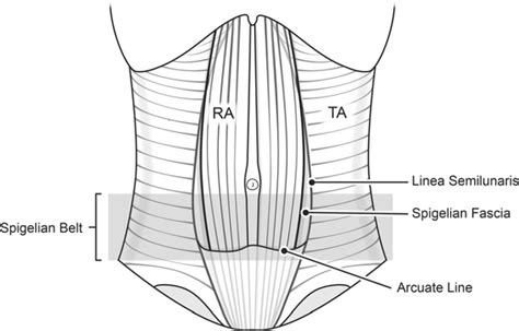 Linea Semilunaris Hernia