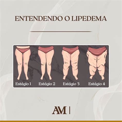 Lipedema O Que Quais Os Sintomas Causas E Tratamento Da Lipedema