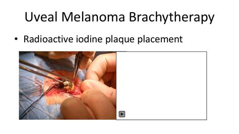 Ocular Melanoma Treatment