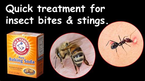 Quick Treatment For Insect Stings Or Bites Home Remedy Baking Soda