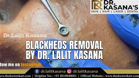 BIG DEEP BLACKHEADS REMOVAL II By Dr Lalit Kasana II BLACKHEADS REMOVAL