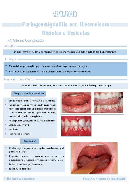 Faringoamigdalitis Con Ulceraciones Juliet Morales Cazaurang UDocz