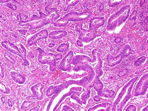 The Histopathological Findings Of The Biopsy From The Ascending Colon Download Scientific