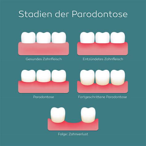 Parodontologie Abbauprozeß des Kieferknochens