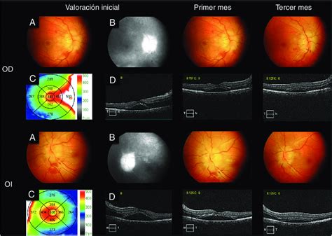 Imagen Compuesta Del Ojo Derecho OD E Izquierdo OI Durante La