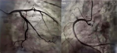 The patient’s coronary angiography results after admission (no obvious ...