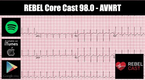 Tachydysrhythmias Archives Rebel Em Emergency Medicine Blog