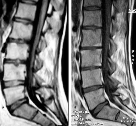 A T Weighted Sagittal Mr Image Shows Decreased Disc Spaces And End