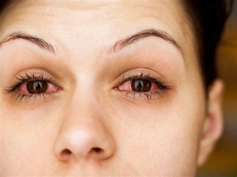 Viral Bacterial Pink Eye Differences And Treatment 54 Off