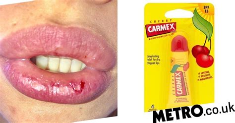 Mum Has Blistered And Bloodied Lips After Using Carmex Lip Balm